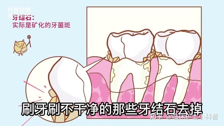 怎么清理牙结石? - 知乎