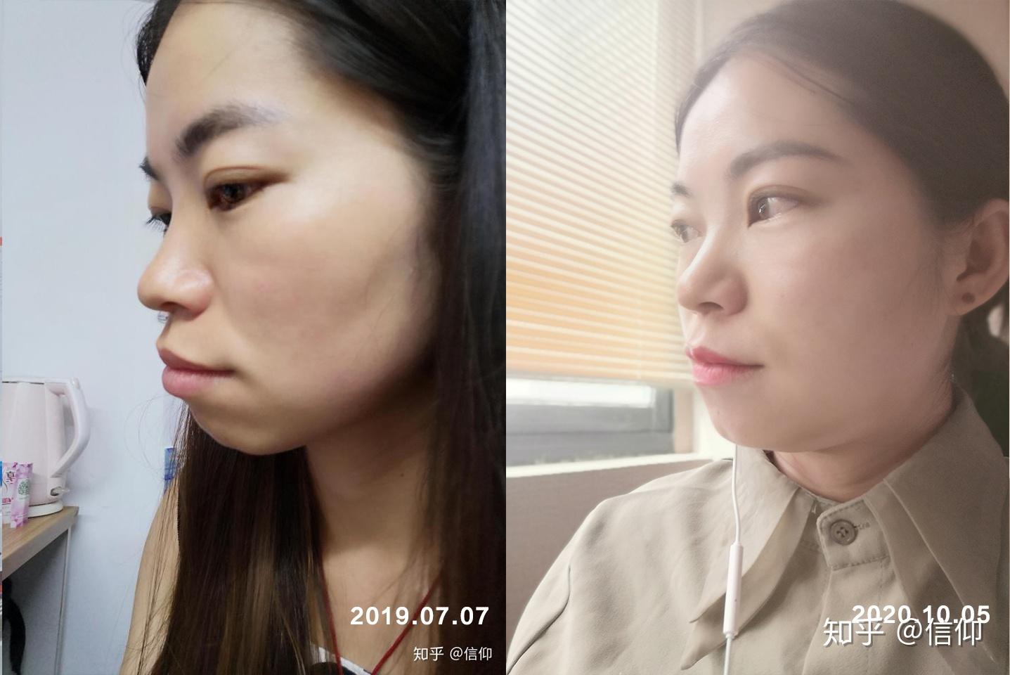 小雅整牙日记一年前后全方位对比图