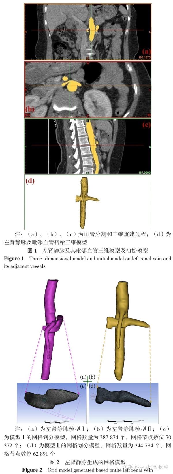 胡桃夹综合征血流动力学的血管建模研究 - 知乎