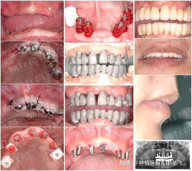 案例分享全口牙列缺失选用全口固定分段式种植义齿修复