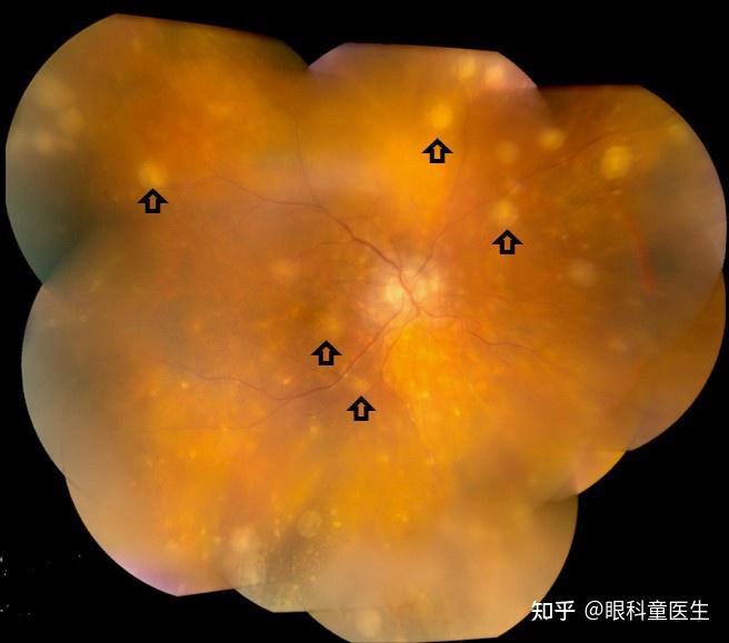 交感性眼炎(sympathetic ophthalmia)