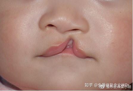 兔唇可以完全治愈吗