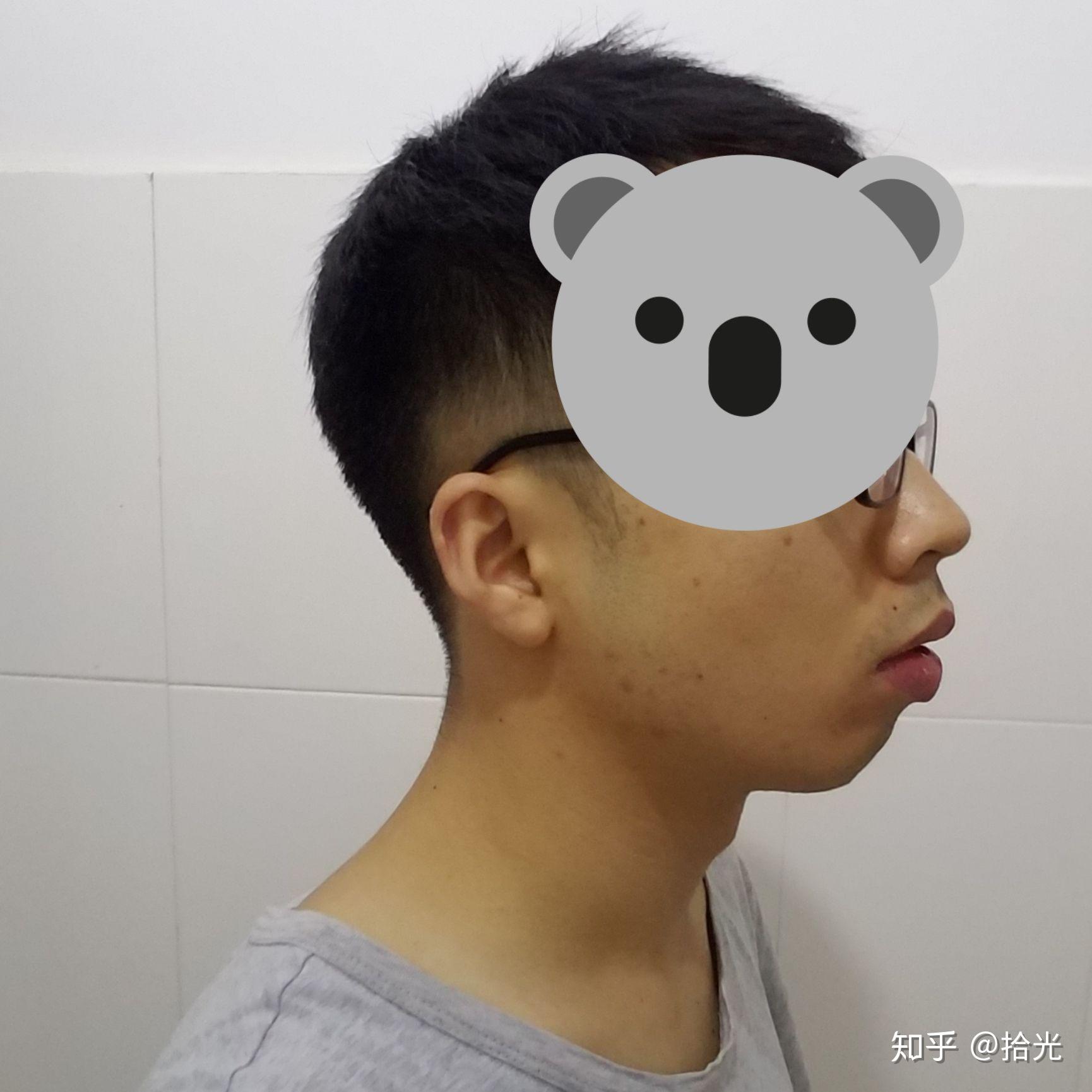 嘴突做mewing有用吗? - 知乎