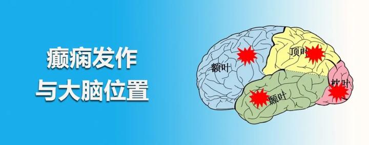 『颞叶、枕叶、顶叶、额叶』四个大脑叶区癫痫发病的区别 - 知乎