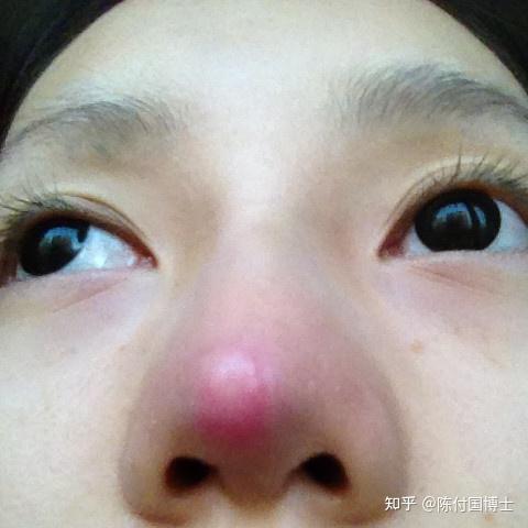鼻感染后严重挛缩如何处理感染如何修复