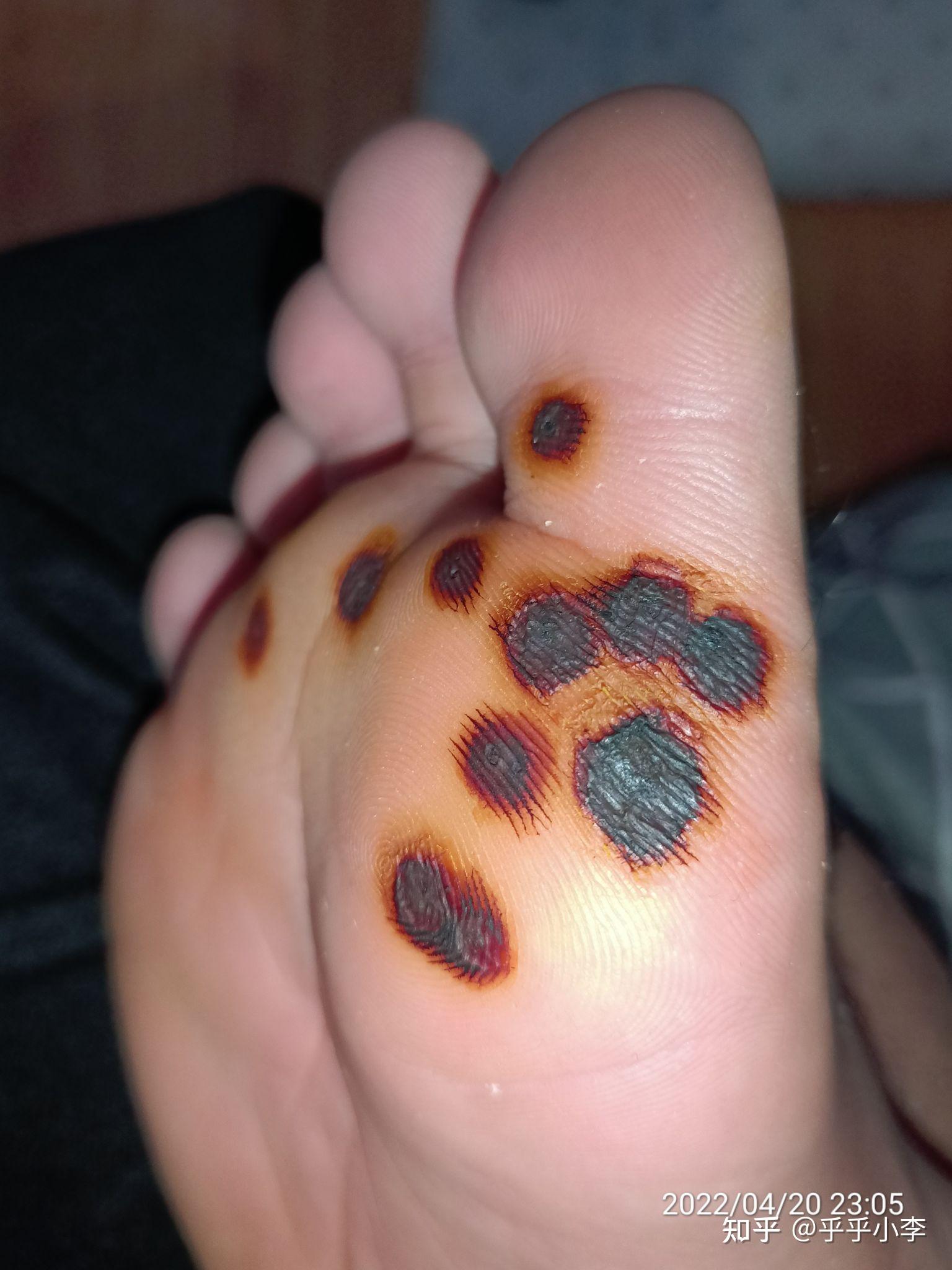 10%浓碘酊治疗跖疣 - 知乎