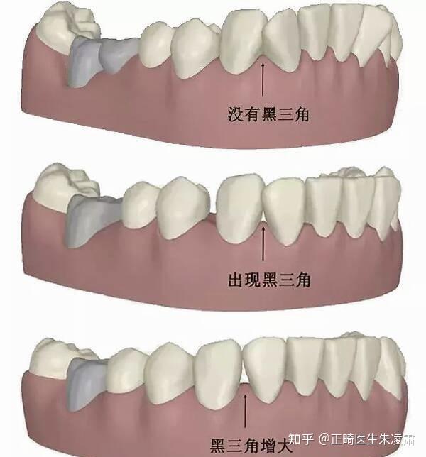 牙齿黑三角是什么?可怕吗?