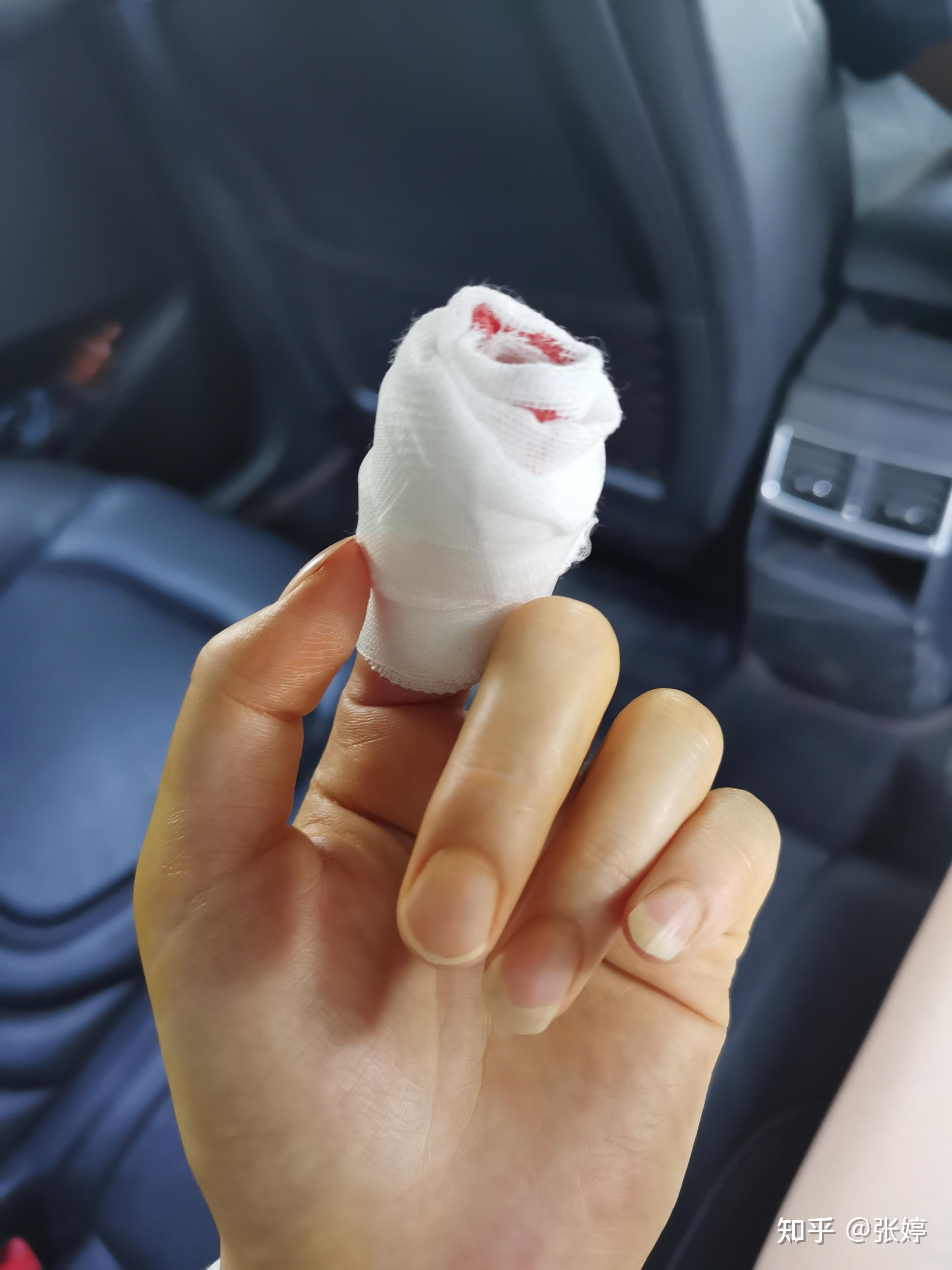 女生食指受伤包扎图片图片