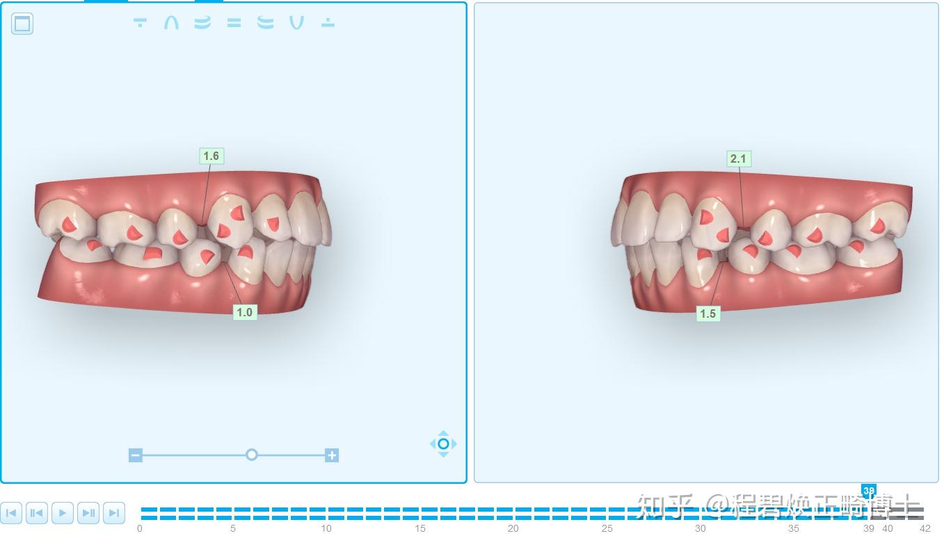 太原牙齿矫正： 牙齿前突、牙列拥挤正畸如何维持直面型？ - 知乎