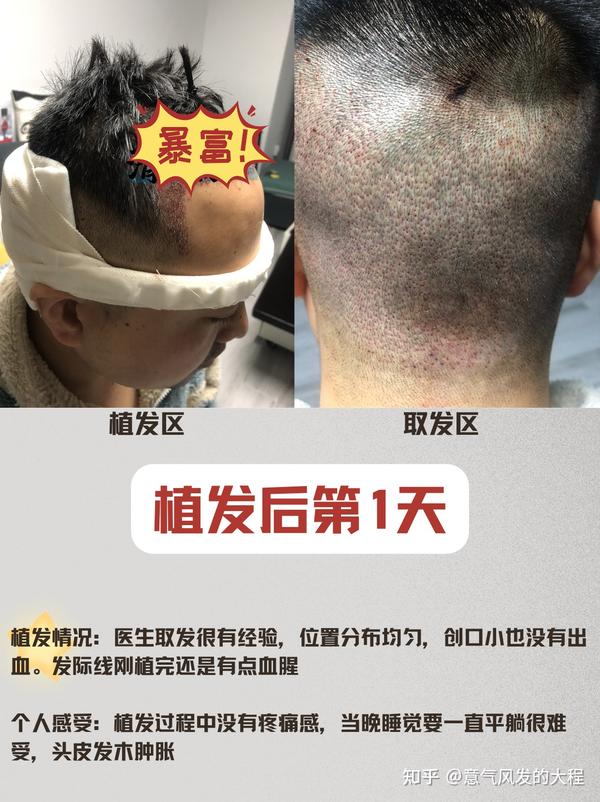 医学硕士植发辛酸史，植发后1-375天的恢复全记录 - 知乎