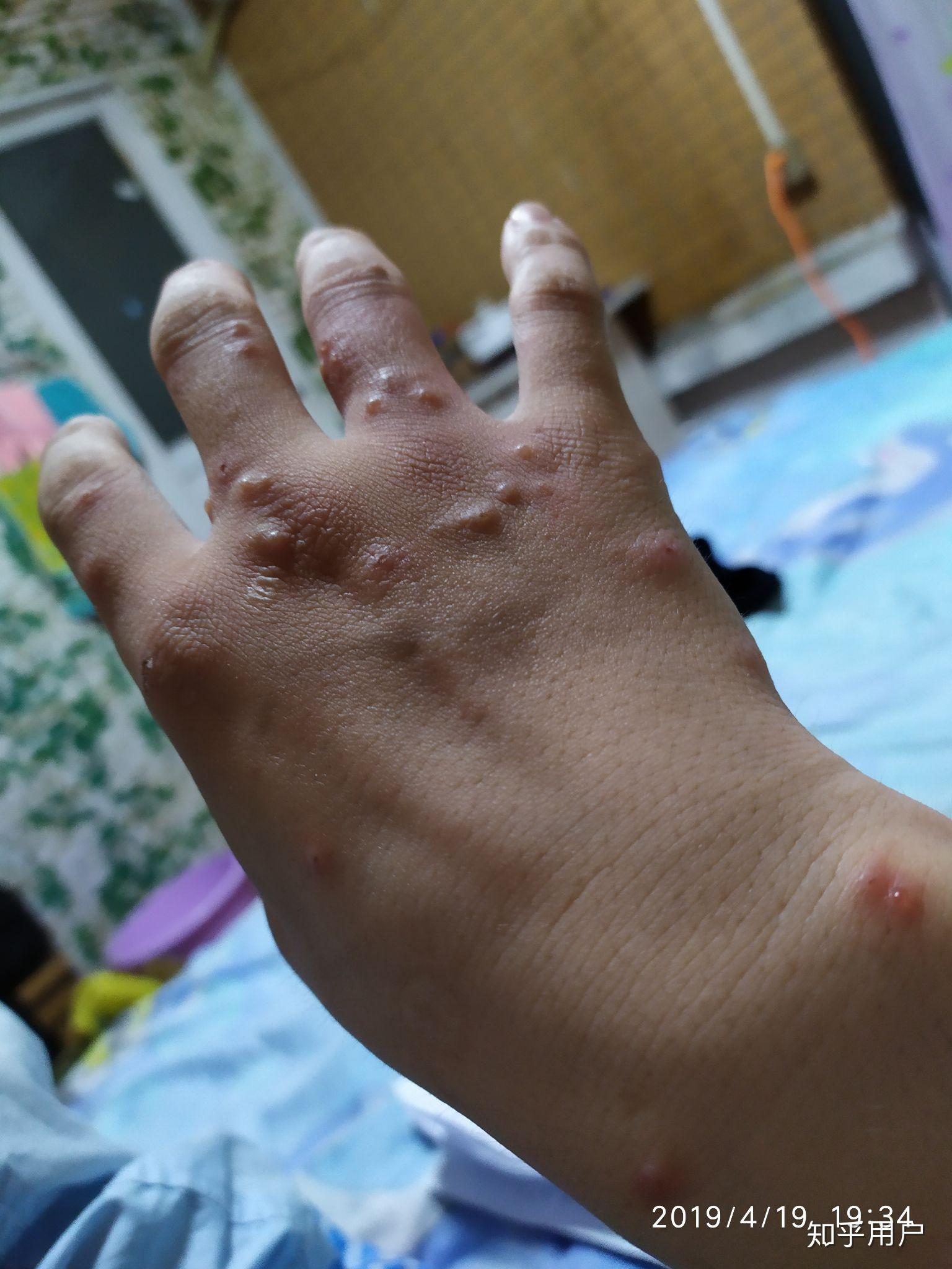 蚊子咬完就过敏怎么破? - 知乎