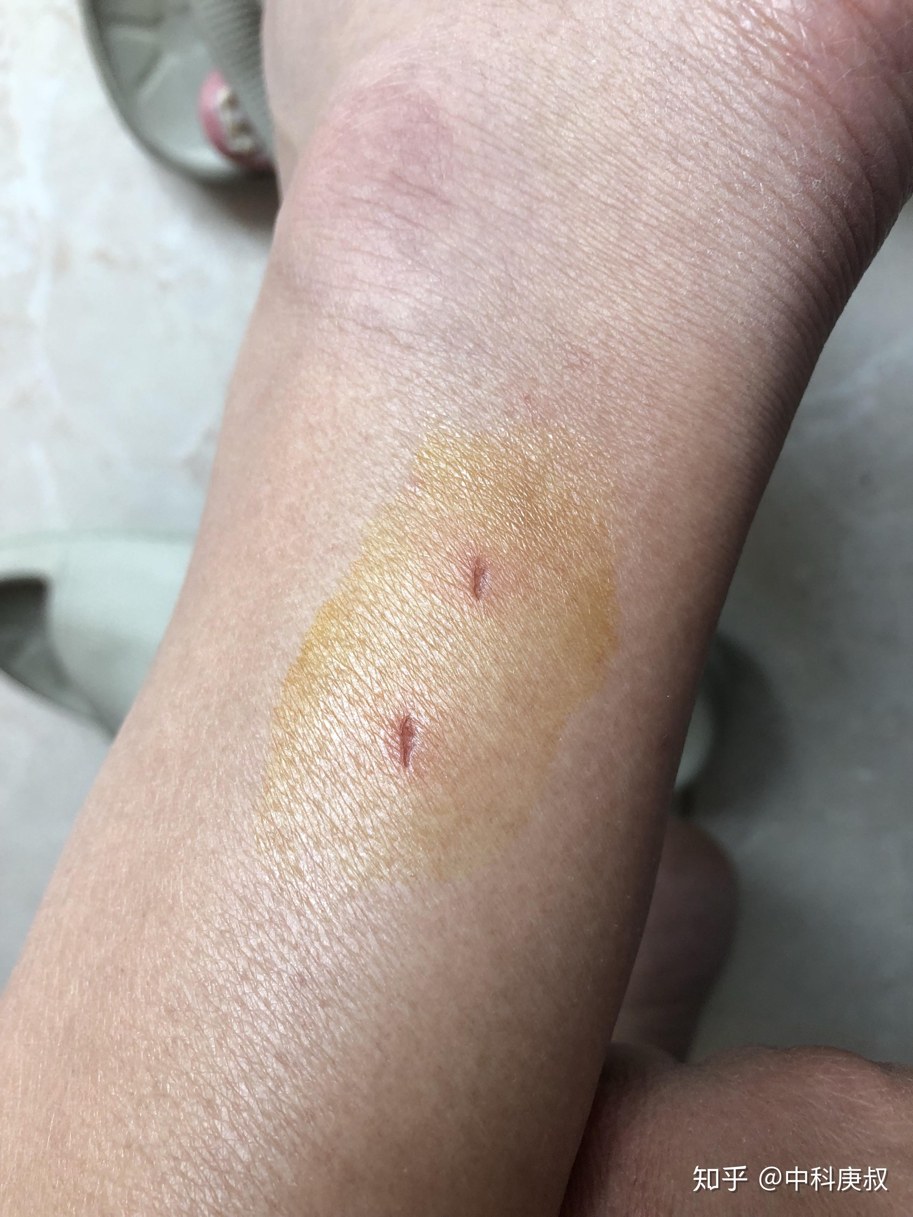 被狗舔了结痂的伤口,需要打狂犬疫苗吗? - 知乎