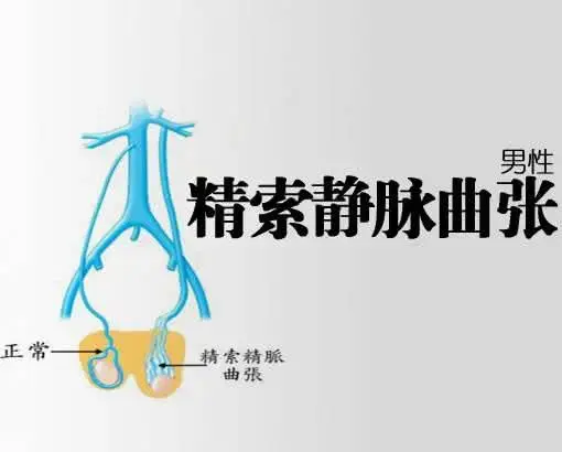 男性精索静脉曲张请不要与它们混淆 - 知乎