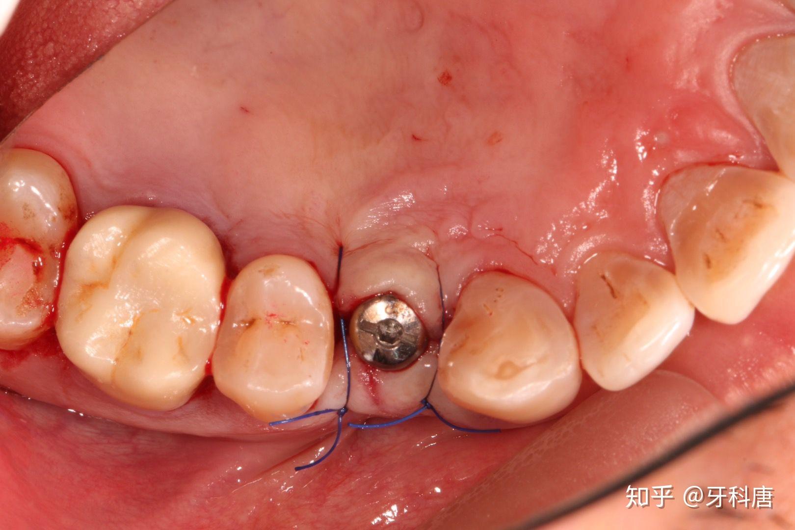 在标准的牙位上图五:牙冠和基台,用于安装牙冠图六:最终效果图,完美