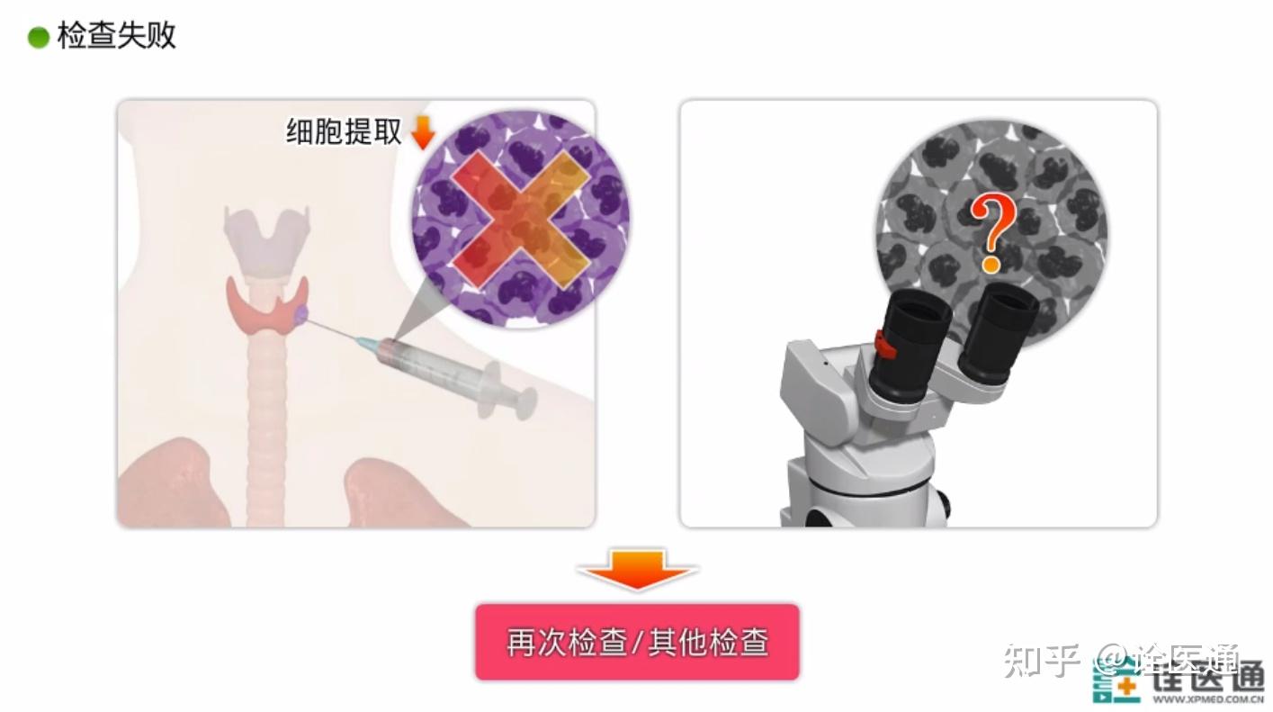 甲状腺细针抽吸细胞学检查