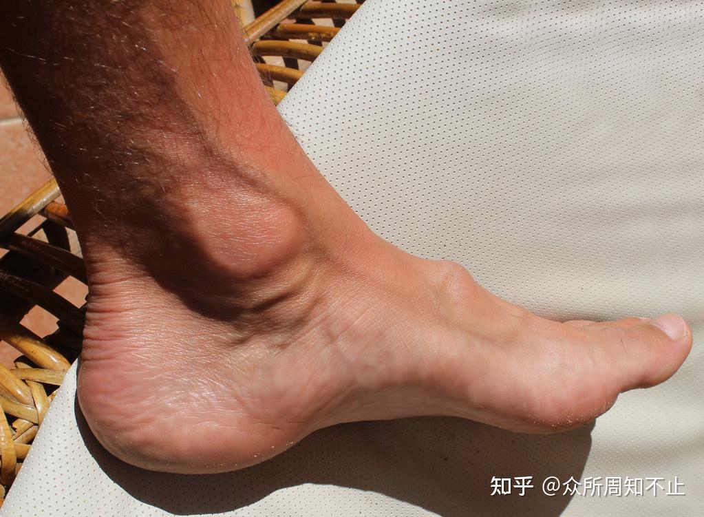 大脚骨走路疼怎么办李茂盛解析