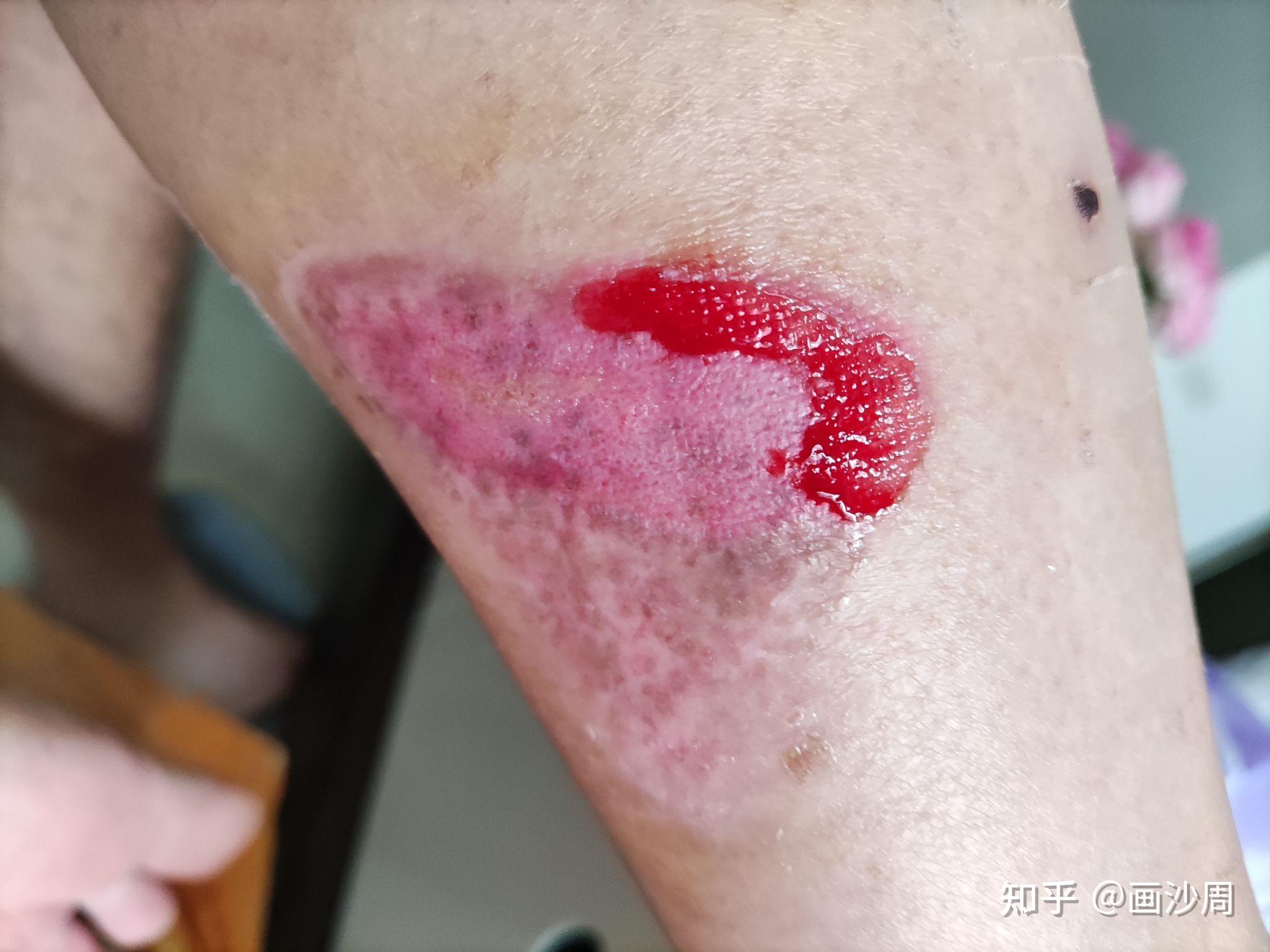 记录摩托车烫伤三度恢复过程