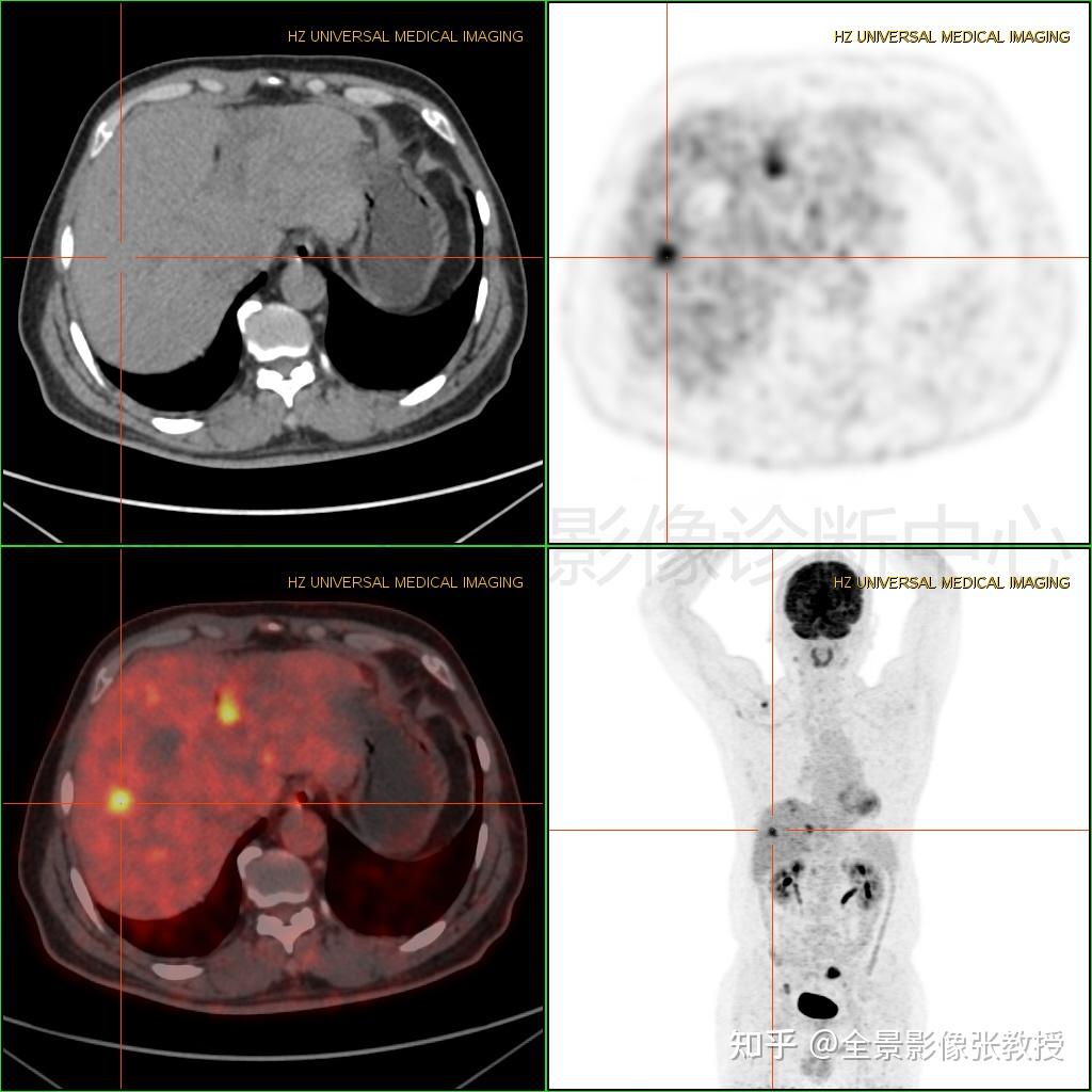 结肠癌术后转移,pet/ct告诉你它转移去哪儿了?