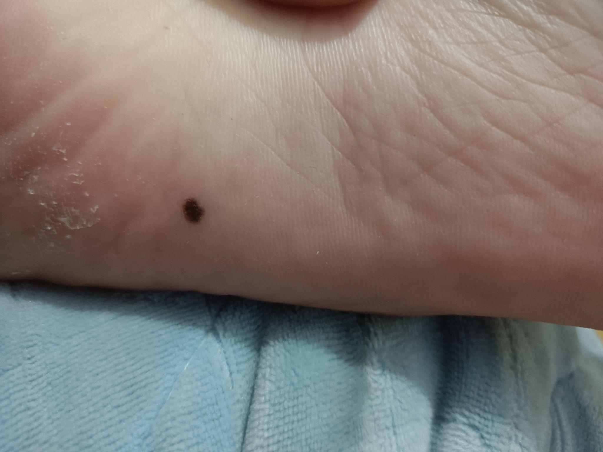 脚底板长了一颗痣? - 知乎