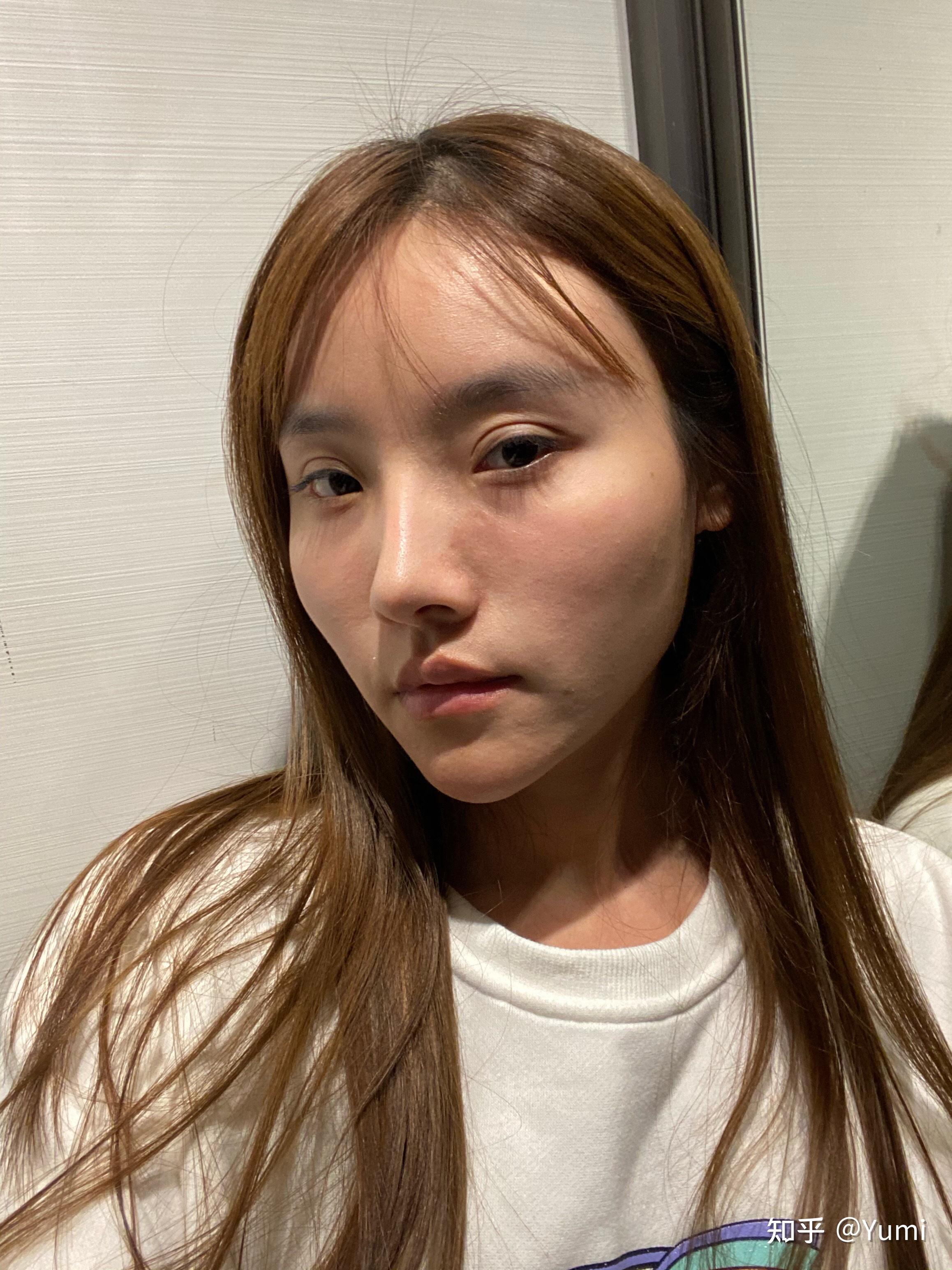 颧骨颧弓重庆磨骨削骨整形全记录——面诊