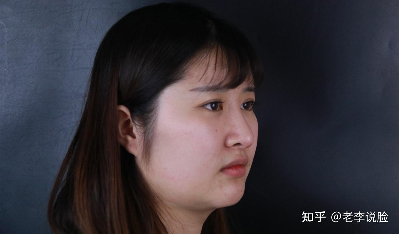 面部吸脂价格大概多少钱_的面部吸脂_面部吸脂会不会导致皮肤松弛