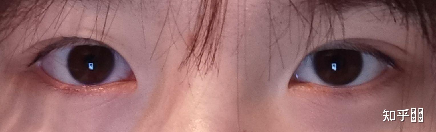 为什么我的眼睛一大一小且歪斜? - 知乎
