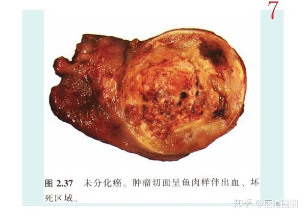 良性病变行腺叶切除术后病理证实为分化型甲状腺癌者,若切缘阴性,对侧