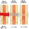 法医谈损伤之骨折篇 知乎