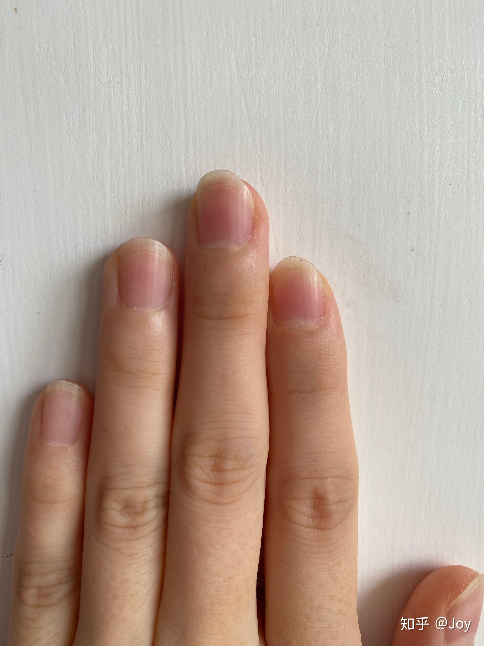 左手大拇指指甲有一条淡褐色竖线,好几年了,微量元素也正常,为什么啊?