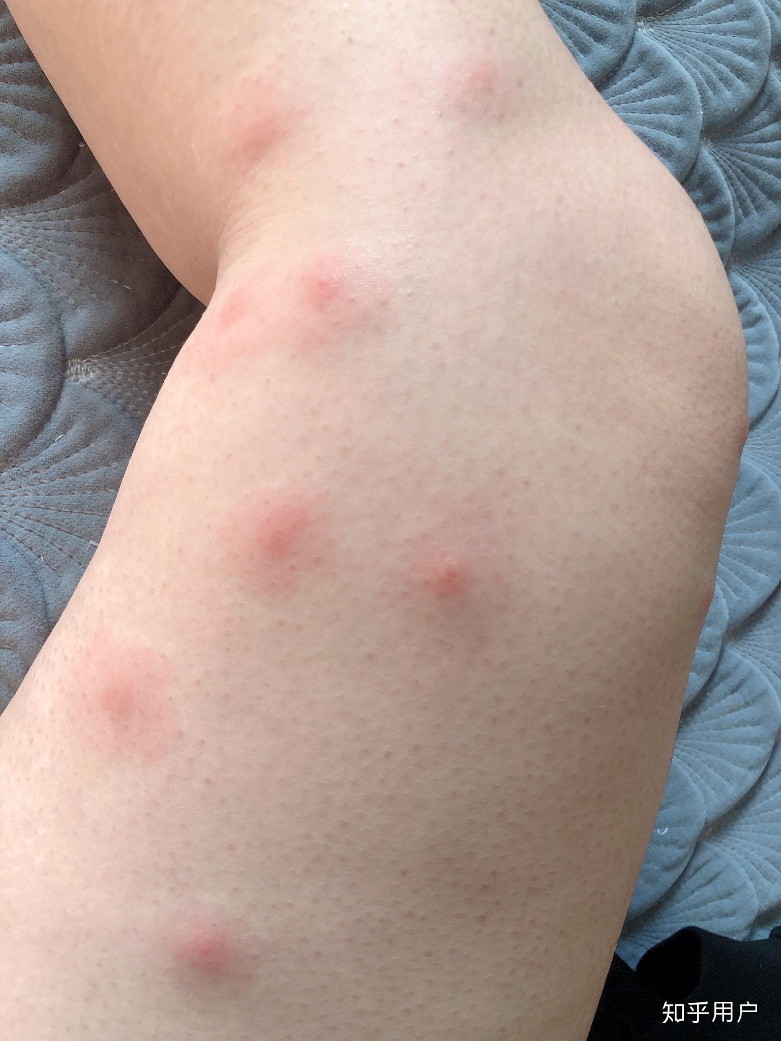 被蚊子咬了红肿起水泡图片