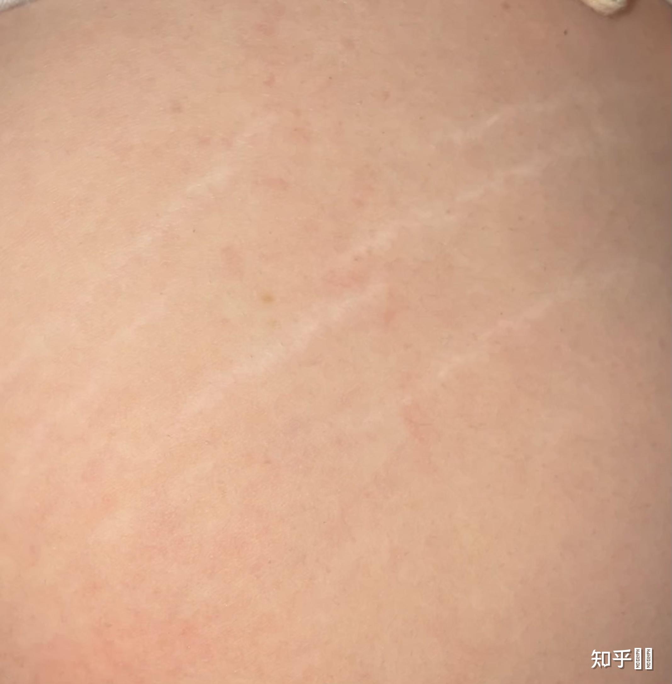 屁股上有生长纹会不会被嫌弃