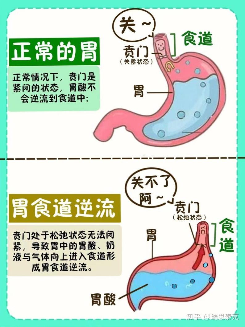 “反流性食管炎”——难言的“酸楚” - 知乎