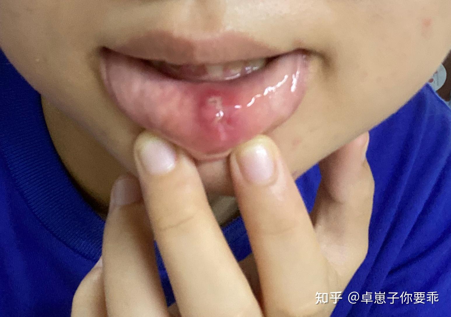 嘴唇粘液腺囊肿手术后?