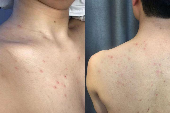 为什么皮肤科医生强烈建议前胸后背出油长痘的时候一定要抑制丙酸杆菌