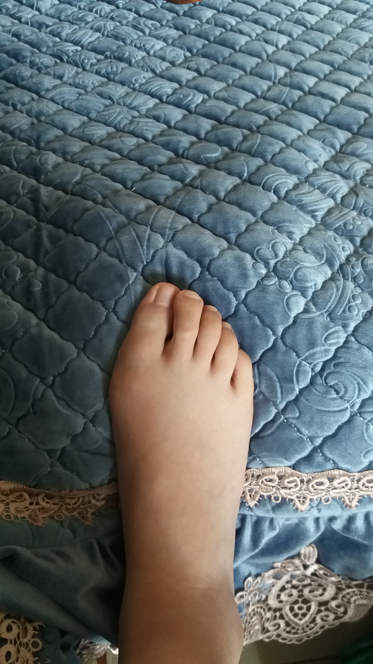 女生脚趾拇外翻是什么样体验