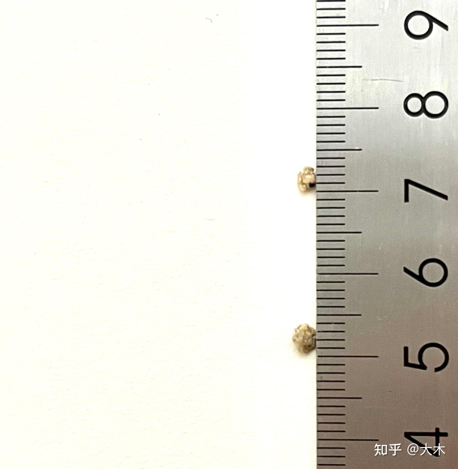 分享一下输尿管结石9mm,三次体外碎石及排石经历. - 知乎