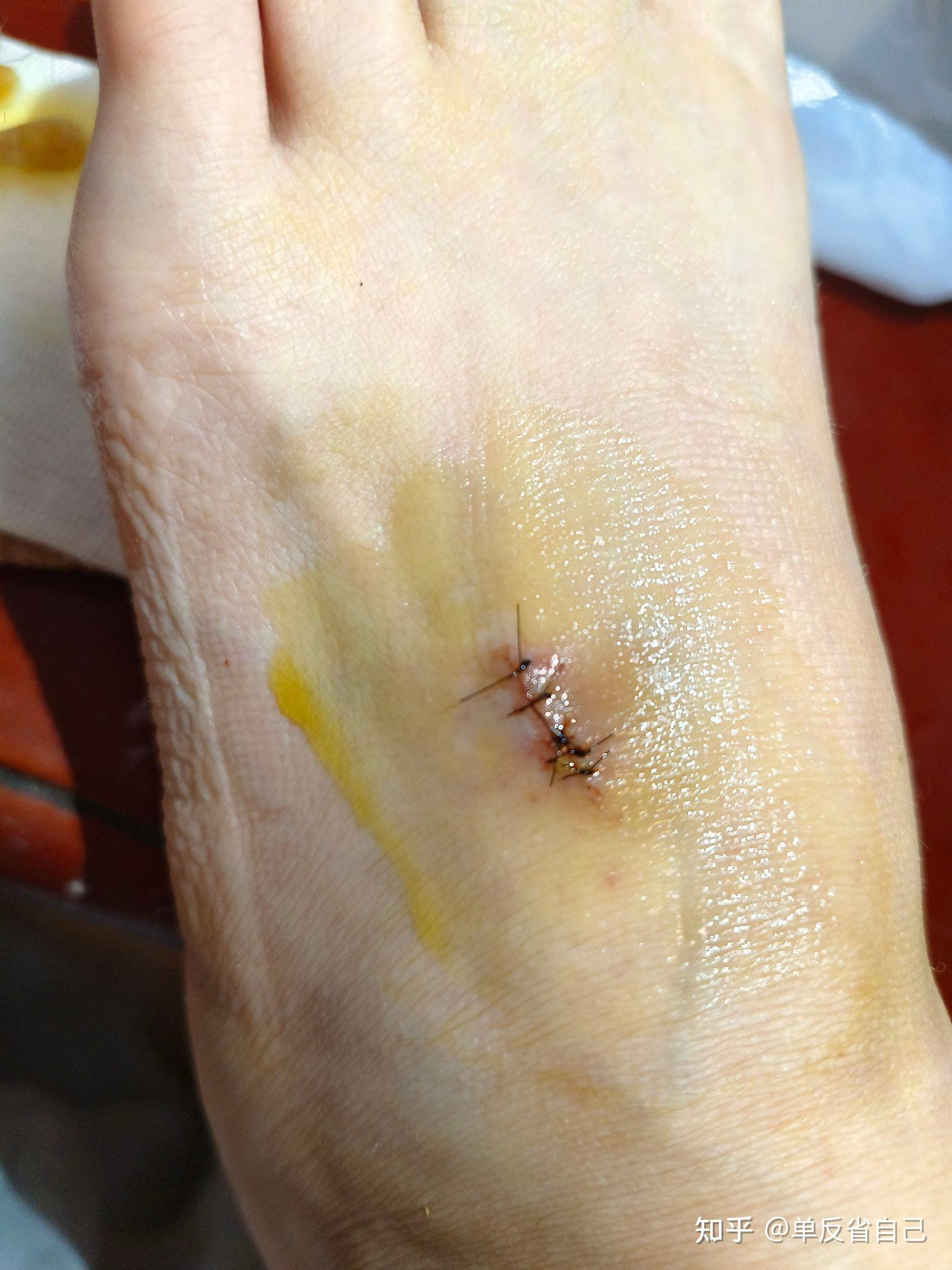 脚背上的血管瘤,终于下定决定去做手术.