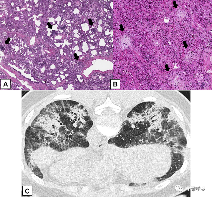 图片[22]-CHEST综述：机化性肺炎的诊断流程（临床-影像-病理特征相关性） | 每周呼吸-每周呼吸