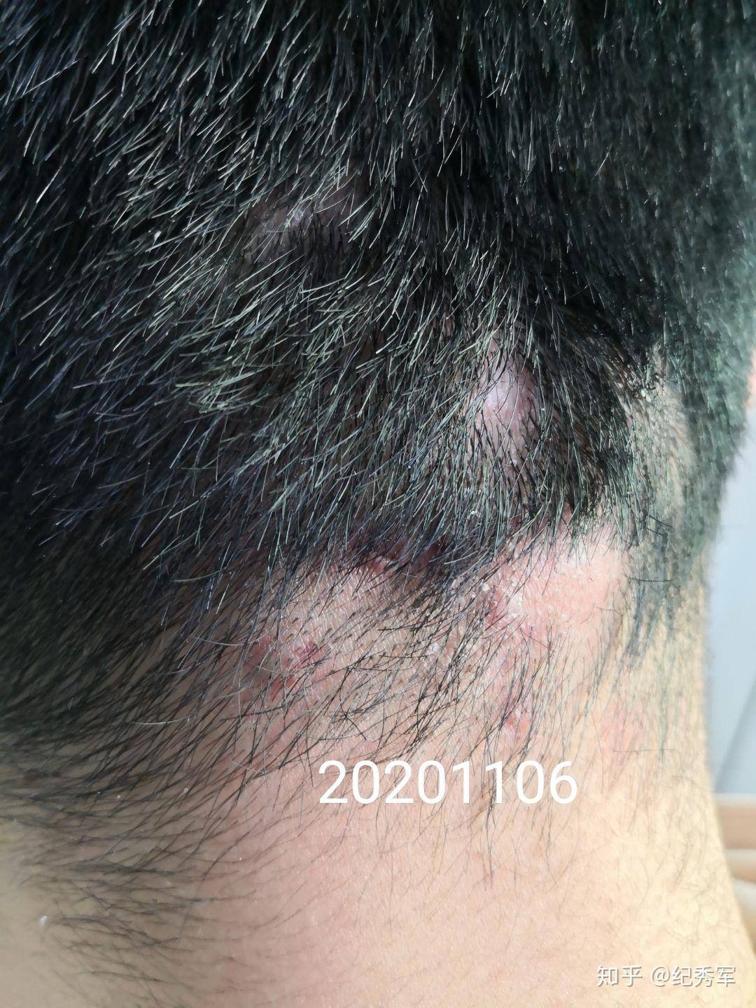 头皮囊肿性痤疮的治疗前后对比