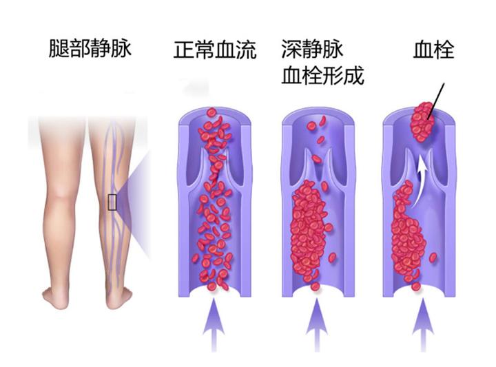 膝关节置换手术后 能不能出去旅行 这里有4点提示 知乎