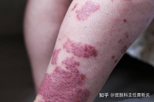银屑病比较严重用生物制剂能停吗