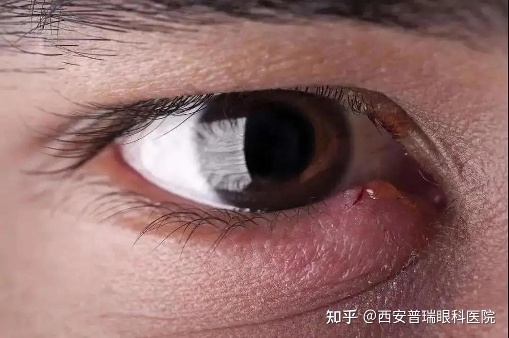 麦粒肿的临床表现 - 知乎