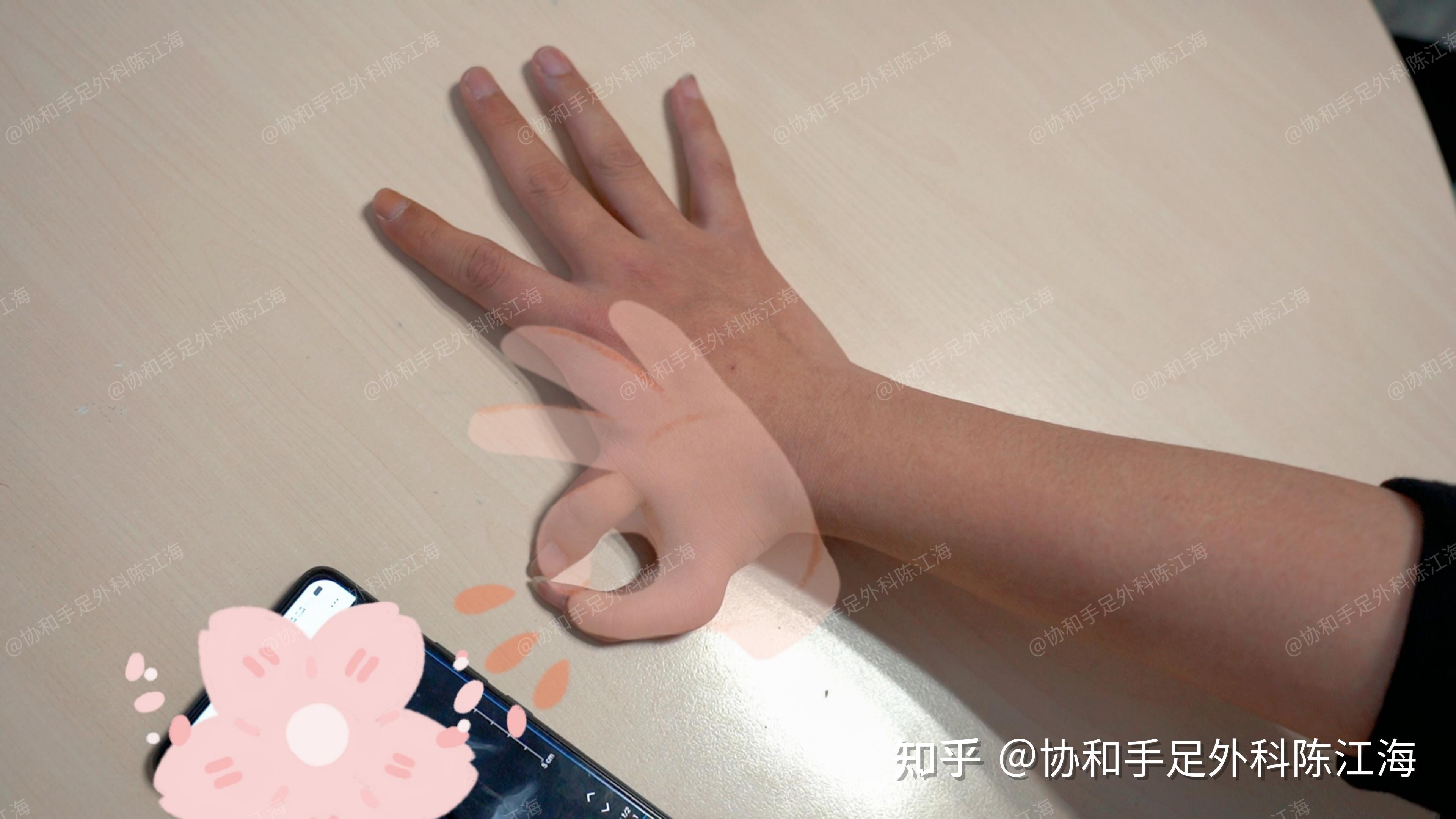 多指手术可以成年后再来做吗?