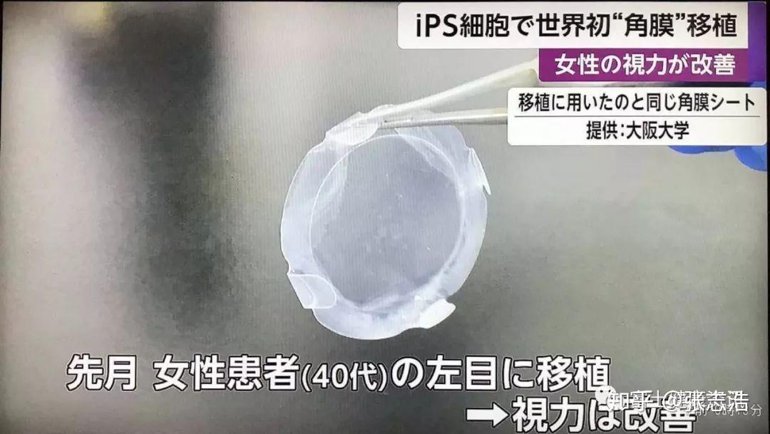 干细胞治疗真的有效吗评大阪大学世界首例ips干细胞角膜移植