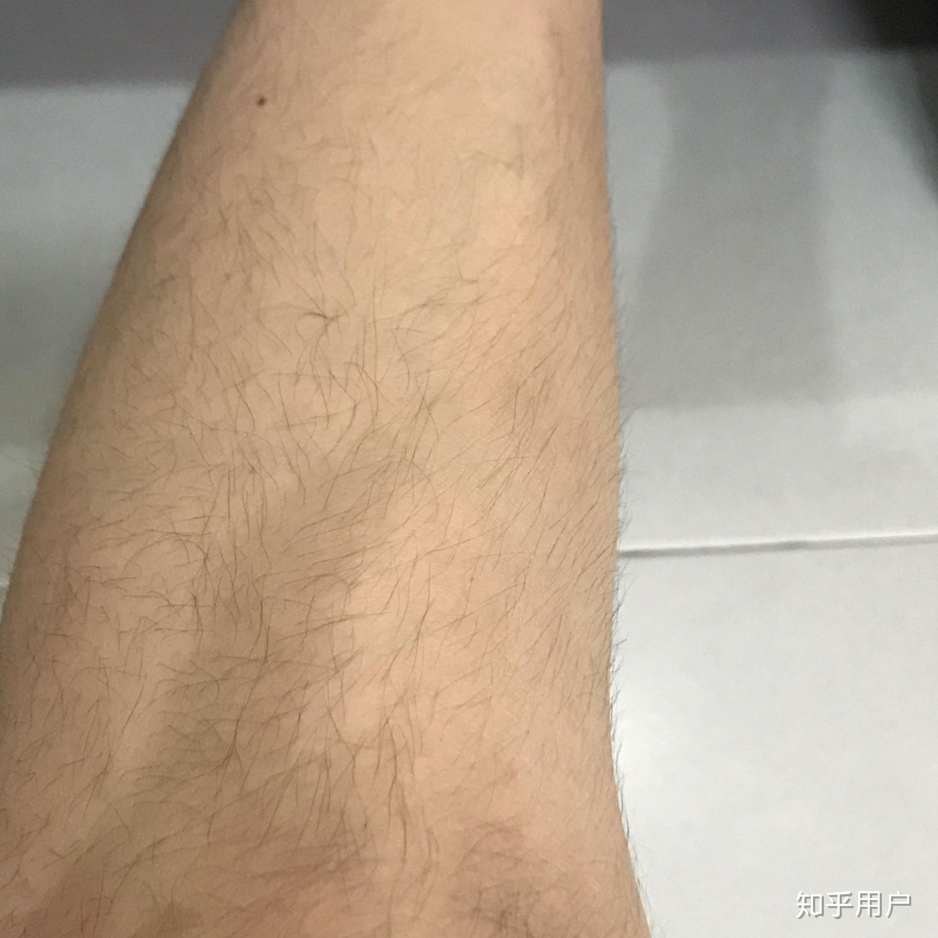 胳膊上汗毛太长怎么办