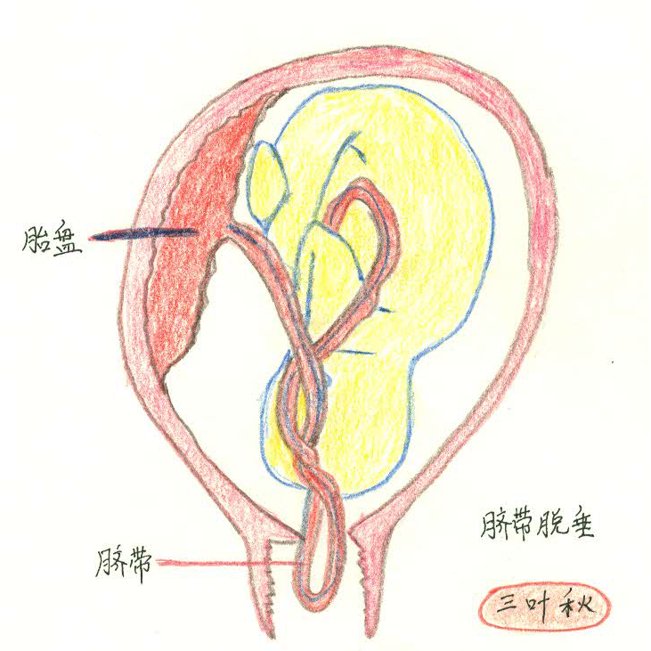 脐带脱垂示意图