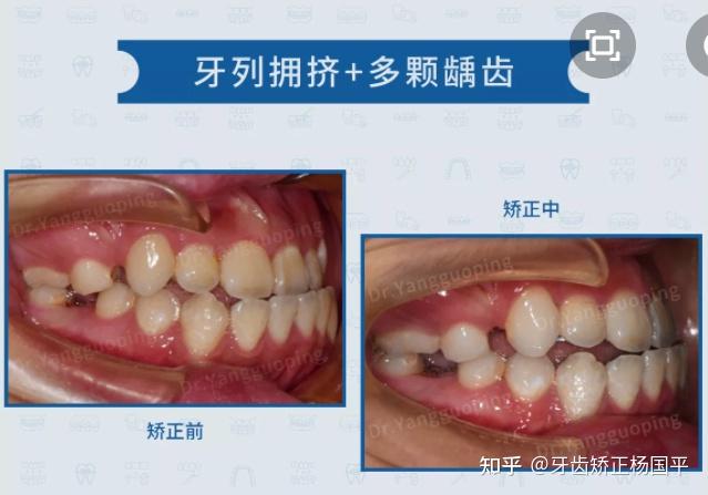 因擁擠導致高位,上頜中線右偏2mm,頦左偏2mm,整個面部左右邊均不對稱