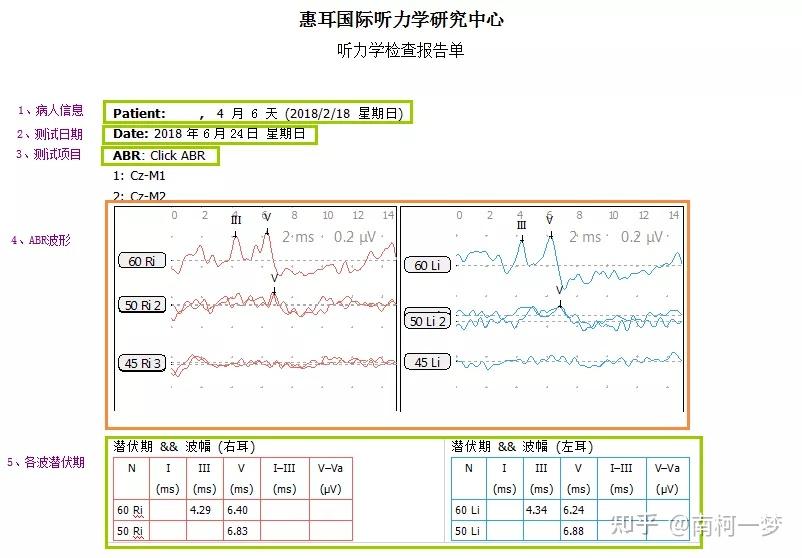 如何看懂电生理报告?(ABR篇) - 知乎