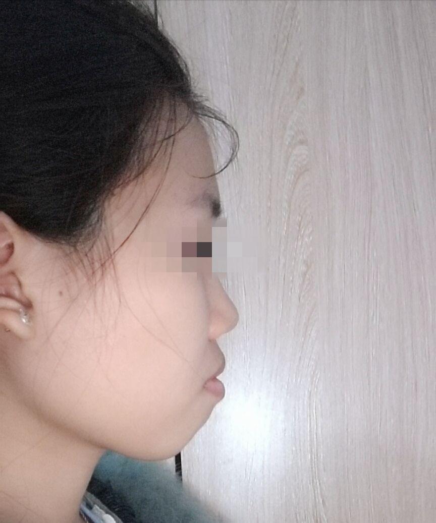 龅牙凸嘴怎么改善侧脸? - 知乎