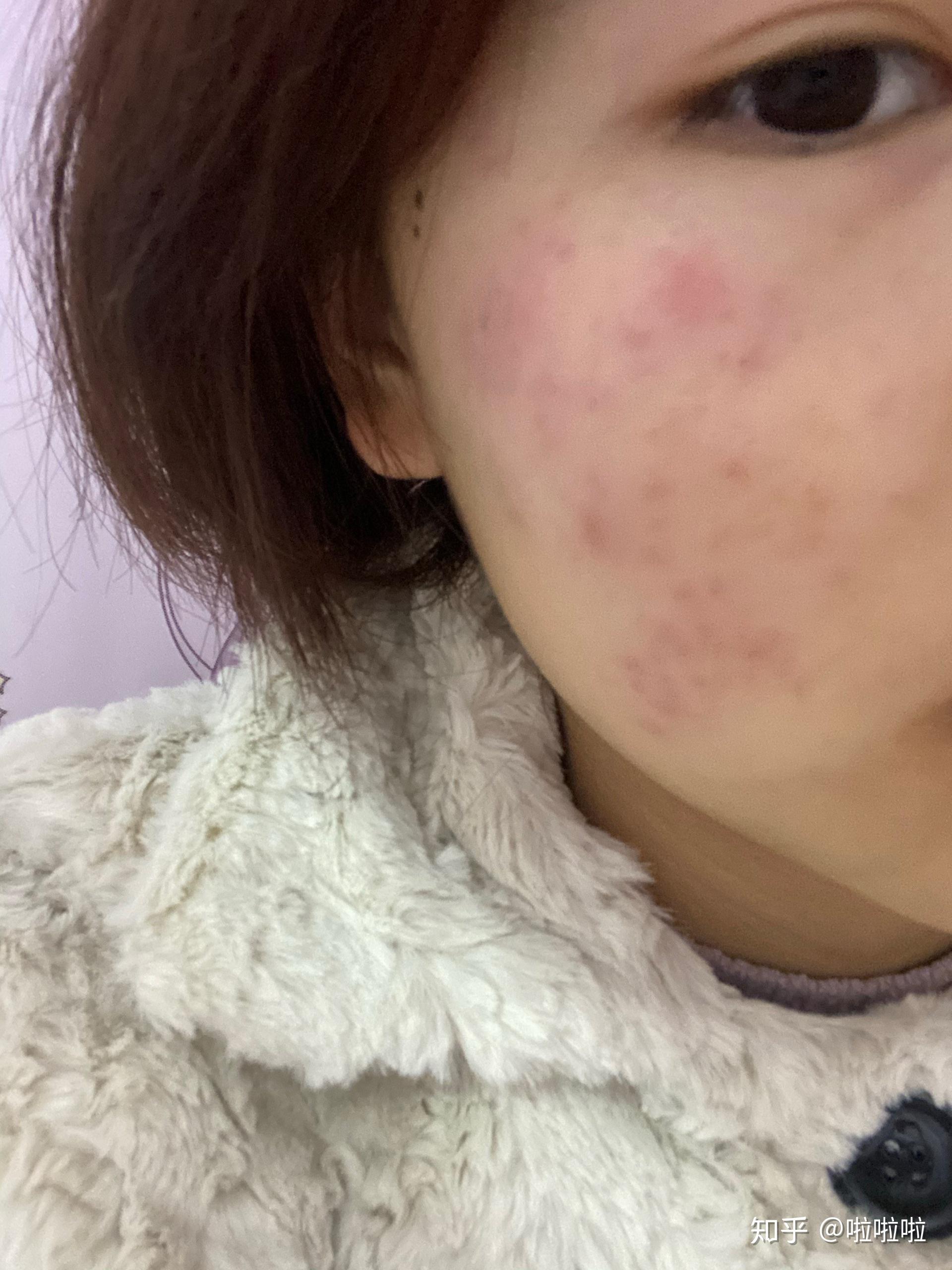 请问你们有用纽西之谜的清洁面膜过敏的吗